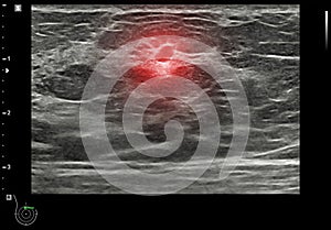 ultrasound  breast of Patient after mammogram  for diagnonsis Breast cancer in women isolated on black background