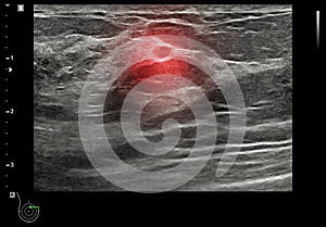 ultrasound  breast of Patient after mammogram  for diagnonsis Breast cancer in women isolated on black background