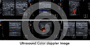 Ultrasound color doppler both leg.