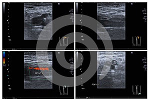 Ultrasound color doppler both leg.