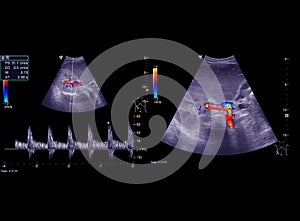 Ultrasound Doppler.