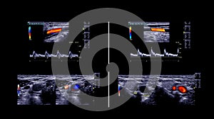 Ultrasound doppler of artery vessel.