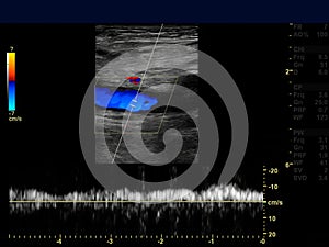 Ultrasound doppler of femoral vien.