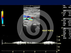 Ultrasound doppler of popliteal vien for finding deep vein thrombosis. photo