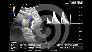 Ultrasound echography gynecological medical examination. Fetus heartbeat recording and thermal analysis