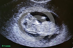 Ultrasound Ecography show baby with 11 weeks gestation