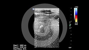 Ultrasound examination of blood vessels.