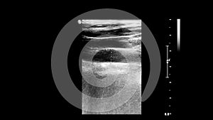 Ultrasound examination of blood vessels.