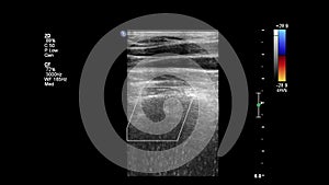 Ultrasound examination of blood vessels.