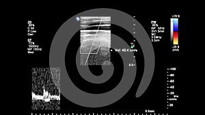 Ultrasound examination of blood vessels.