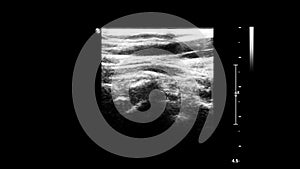 Ultrasound examination of blood vessels in grayscale mode.