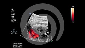 Ultrasound examination of the fetal heart