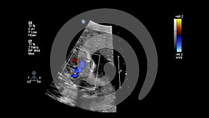 Ultrasound examination of the fetal heart