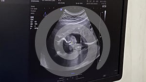 Ultrasound of an Expecting Mother and Her Miracle