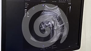 Ultrasound of an Expecting Mother and Her Miracle