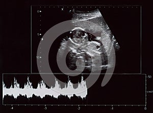 Ultrasound of fetus