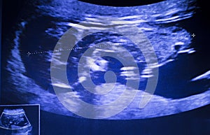 Ultrasound foetus pregnancy scan