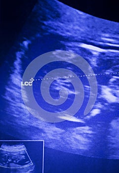 Ultrasound foetus pregnancy scan