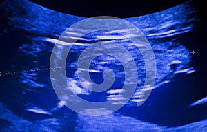 Ultrasound foetus pregnancy scan