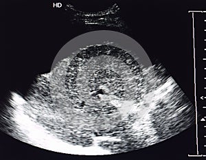 Ultrasound image of liver cirrhosis photo