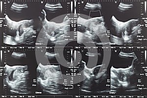 Ultrasound image of lower abdomen, ovary and uterus with tumor or uterine fibroid, leiomyoma of female woman patient for gynecolog photo