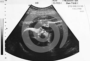 Ultrasound photo of unborn baby in mother`s womb