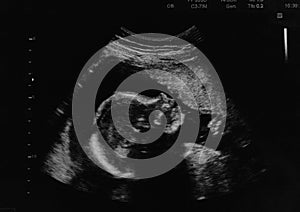 Ultrasound photo of unborn baby in mother`s womb