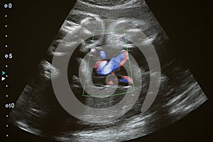 Ultrasound photo of unborn baby in mother`s womb, closeup view