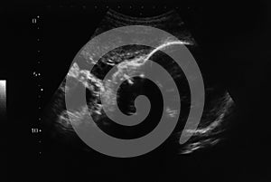 Ultrasound photo of unborn baby in mother`s womb