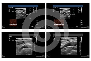 Ultrasound picture of carotid artery