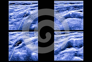 Ultrasound picture of carotid artery photo