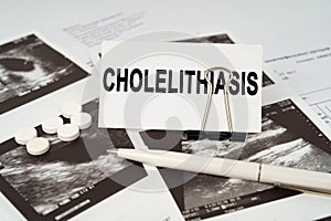 On the ultrasound pictures there is a pen and a business card with the inscription - Cholelithiasis photo