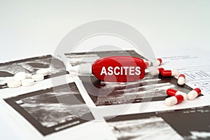 On the ultrasound pictures there are pills and a pen with the inscription - Ascites