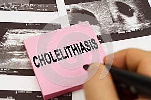 On the ultrasound pictures there are stickers that say - Cholelithiasis photo