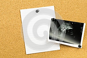 Ultrasound pregnancy photo on cork board. Baby fetus photo as a first pregnancy sticky note