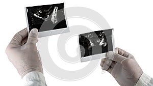 Ultrasound of the prostate isolated on white background, picture of the male prostate at the doctor`s hands.