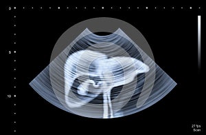 Ultrasound scan of humal liver.