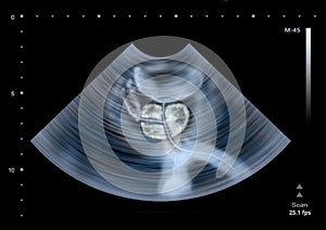 Ultrasound scan of human Prostate