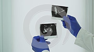 An ultrasound scan of the prostate, in the hands of a doctor, an ultrasound of the prostate gland, an analysis for prostate