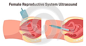 Ultrasound scanning. Female reproductive system research. Gynecological disease