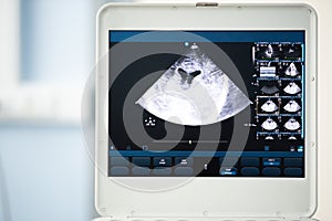 The ultrasound screen with the image of the brain and ventricles