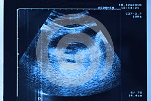 Ultrasound of stomach