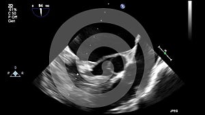 Ultrasound transesophageal examination of the heart.