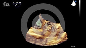 Ultrasound transesophageal examination of the heart.