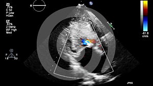 Ultrasound transesophageal examination of the heart.