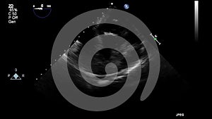 Ultrasound transesophageal examination of the heart.