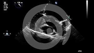 Ultrasound transesophageal examination of the heart.