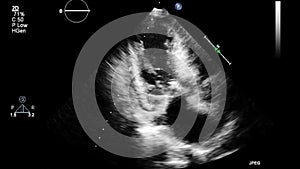 Ultrasound transesophageal examination of the heart.