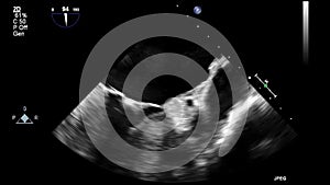 Ultrasound transesophageal examination of the heart.