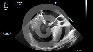 Ultrasound transesophageal examination of the heart.